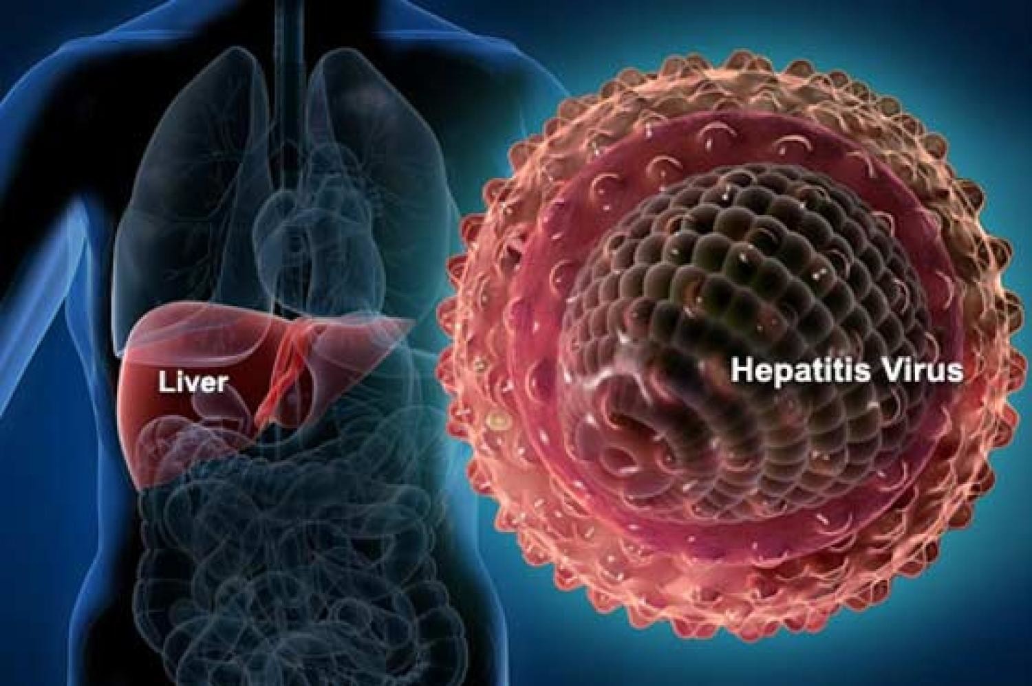 Hepatitis C Kronis, Sirosis Hati Dan Kanker Hati - Yayasan ...